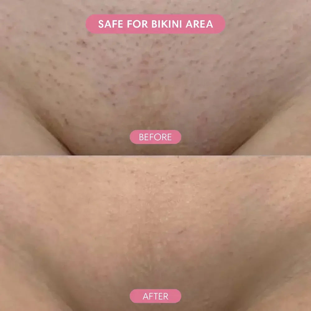 Before and after bikini area skin treatment, showing reduced bumps and smoother skin