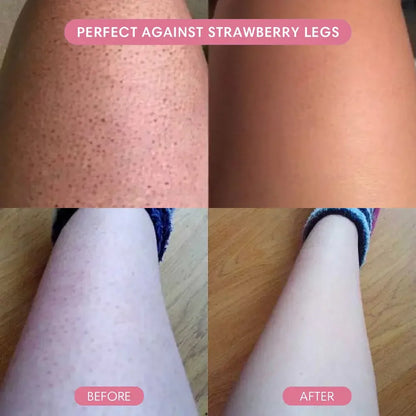 Before and after photo showing treatment for strawberry legs, smooth skin results