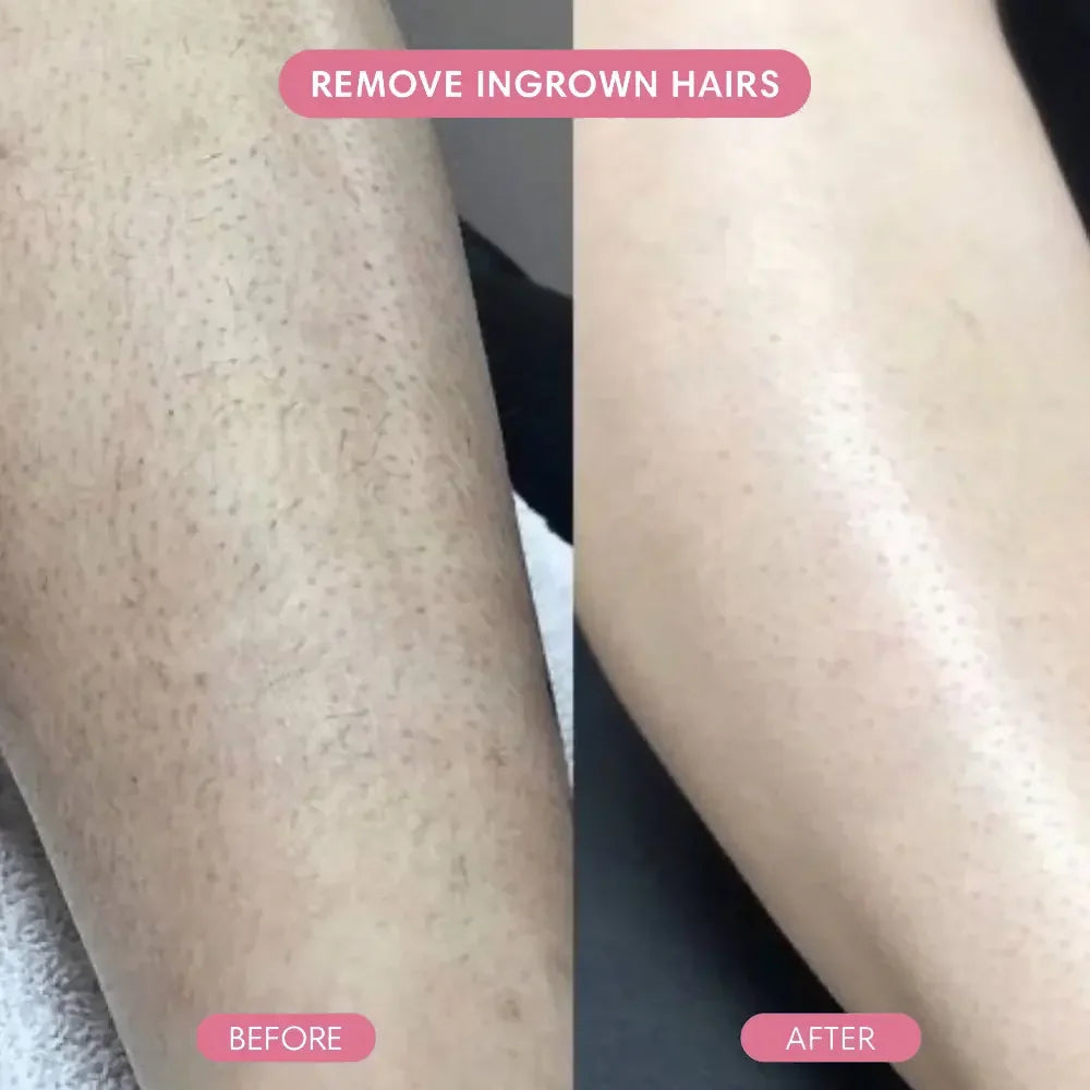 Before and after ingrown hair removal on leg, smooth skin results comparison