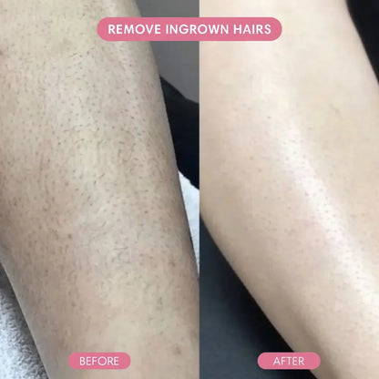 Before and after ingrown hair removal on leg, smooth skin results comparison